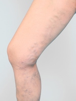 Krampfadern , Stammvarikosis, Vena saphena magna, beste Behandlung ist Stripping oder Laser oder Radiofrequenz